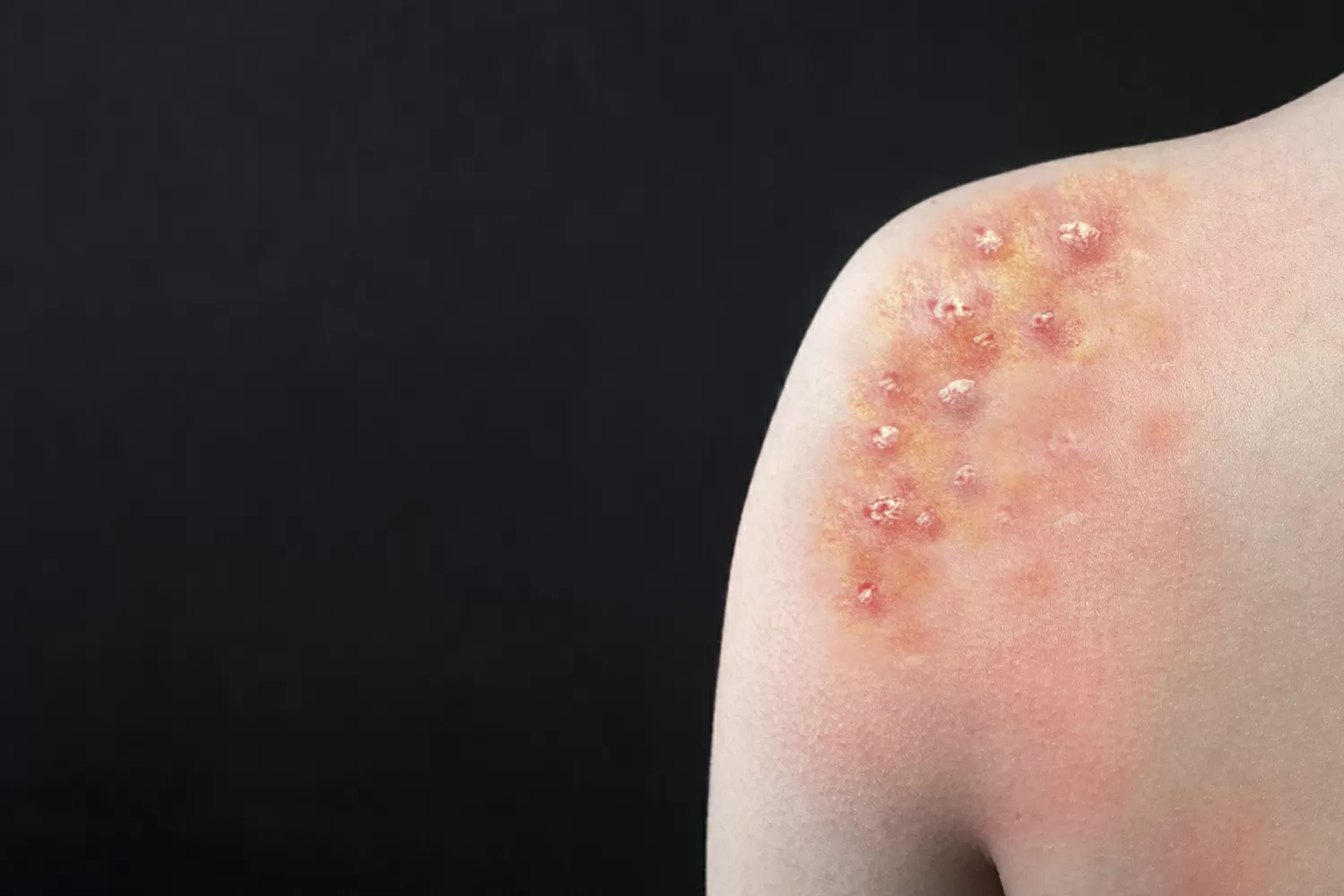 Porto Alegre confirma caso de Mpox e prefeitura faz alerta para Carnaval