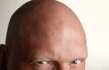 Transplantes capilares viram grande negócio, mas tratamento tem riscos