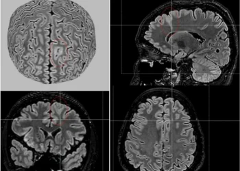 Ferramenta de IA é capaz de detectar anormalidades cerebrais invisíveis