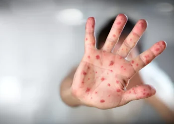 Rio confirma dois casos de sarampo na Baixada Fluminense