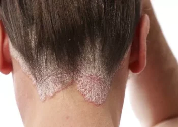 Alimentação pode influenciar sintomas da psoríase, aponta estudo