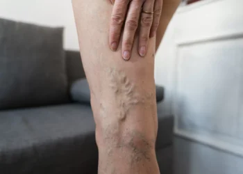 A doença venosa crônica e a urgência de novos dados