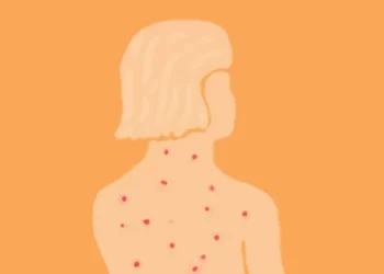 São Paulo registra segundo caso de sarampo importado e intensifica vacinação