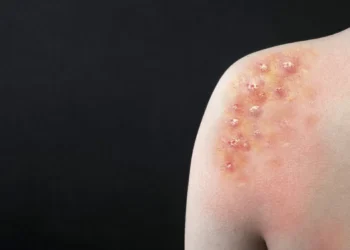 Porto Alegre confirma caso de Mpox e prefeitura faz alerta para Carnaval