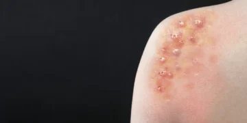 Porto Alegre confirma caso de Mpox e prefeitura faz alerta para Carnaval